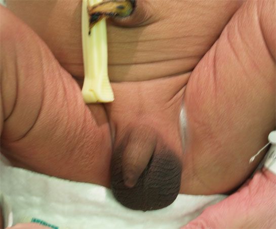 Normal male genitalia.jpg